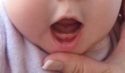 Как обрабатывать ребенку рот при стоматите содой thumbnail