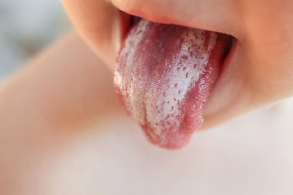Как почистить язык ребенку пищевой содой от молочницы